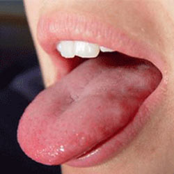 زخم زبان سرطان می آورد!