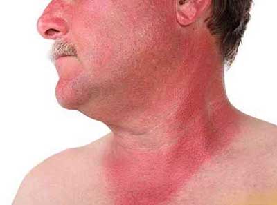 آفتاب سوختگی و درمان های خانگی موثر 